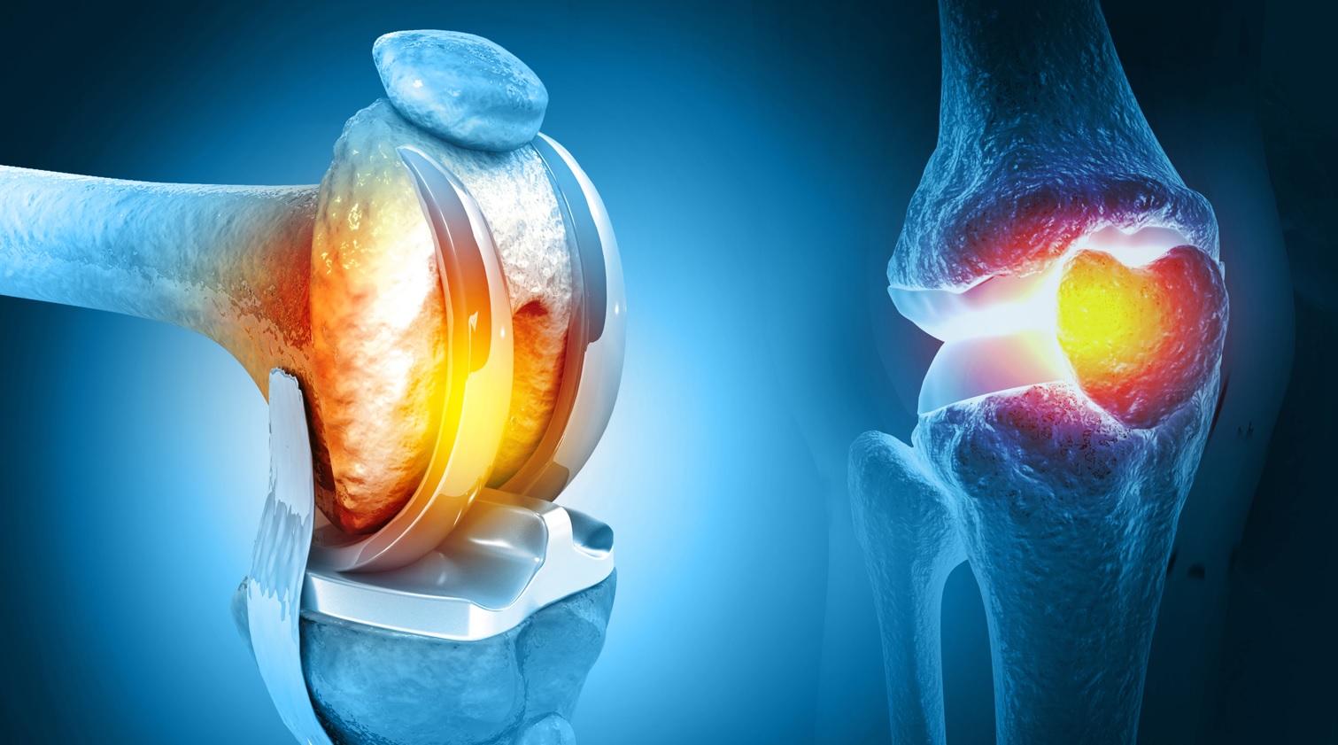 Joint Replacement